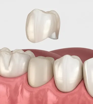 Коронки на зуб