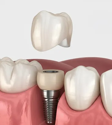 Коронки на зуб