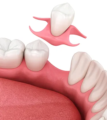 Коронки на зуб