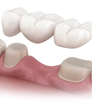 Коронки на зуб